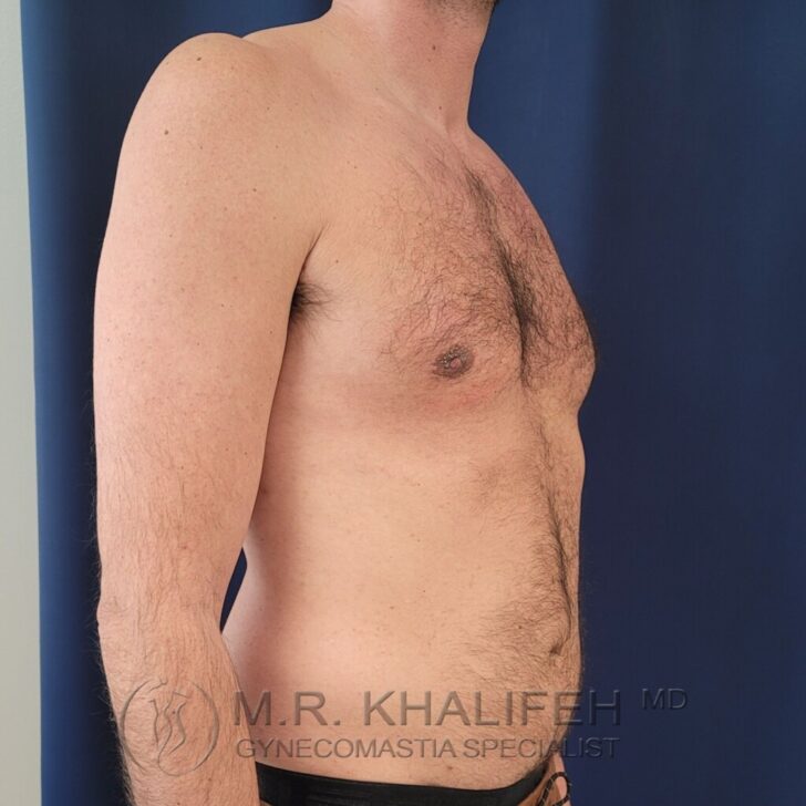 A shirtless adult male stands in profile against a dark blue background. The logo "M.R. Khalifeh MD Gynecomastia Specialist" is visible at the bottom of the image.