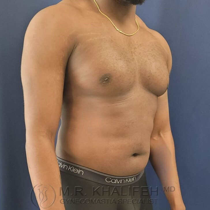 A shirtless male with mild chest prominence and a visible gold necklace, standing against a blue background. The photo includes a watermark for a gynecomastia specialist.