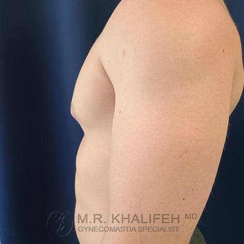Side view of a shirtless male torso showing gynecomastia, with the logo and name of a gynecomastia specialist at the bottom of the image.