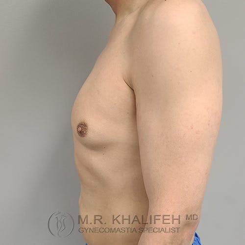 A shirtless male torso is shown from the side against a plain background, with the logo and name "M.R. Khalifeh MD Gynecomastia Specialist" at the bottom.