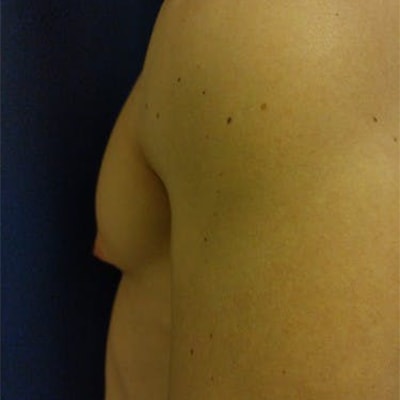 A close-up side view of a person’s bare upper torso and shoulder with several small moles visible on their skin.