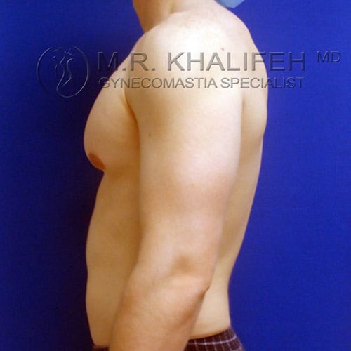 Side view of a shirtless male torso against a blue background, showing mild gynecomastia. Text overlay indicates a gynecomastia specialist.