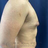 Side view of a shirtless male torso with visible gynecomastia, showing enlarged breast tissue; blue background and doctor’s watermark at the bottom.