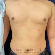A shirtless person stands facing forward, showing a flat chest with visible nipples and some mild skin discoloration on the right side. The image has a watermark at the bottom.