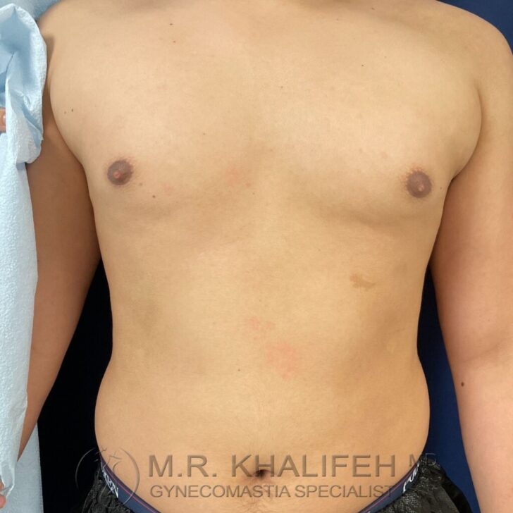 A shirtless person stands facing forward, showing a flat chest with visible nipples and some mild skin discoloration on the right side. The image has a watermark at the bottom.