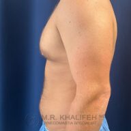 Side view of a shirtless adult male with visible gynecomastia, standing against a dark blue background, wearing blue medical shorts.