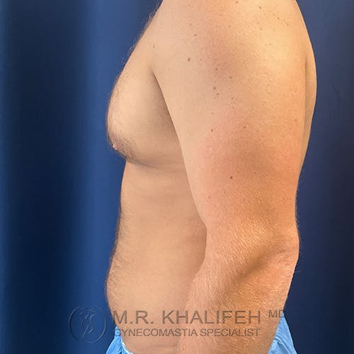 Side view of a shirtless adult male with visible gynecomastia, standing against a dark blue background, wearing blue medical shorts.