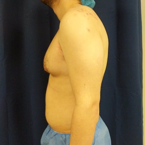 Side view of a shirtless adult male standing against a dark curtain, wearing blue medical scrubs and a surgical cap, with some visible marks on the upper back.