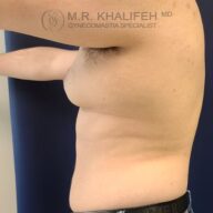 A close-up side view of a man's bare torso with visible gynecomastia; his right arm is raised, and text reads "M.R. Khalifeh MD, Gynecomastia Specialist.