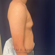 Side view of a shirtless person with visible breast tissue, standing against a dark background. The image includes a watermark with a doctor's name and title.