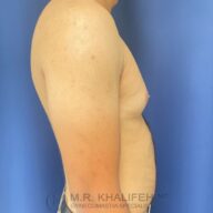 Side view of a shirtless adult male torso against a blue background, showing mild chest protrusion. "M.R. Khalifeh MD Gynecomastia Specialist" watermark is visible.