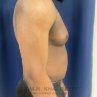A side view of a shirtless person with visible gynecomastia, standing in front of a blue curtain. The watermark reads "M.R. Khalifeh MD Gynecomastia Specialist.
