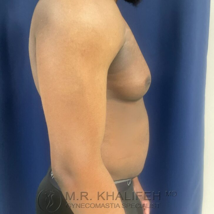 A side view of a shirtless person with visible gynecomastia, standing in front of a blue curtain. The watermark reads "M.R. Khalifeh MD Gynecomastia Specialist.