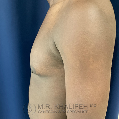 A side view of a shirtless person with a flat chest, standing against a blue background. The watermark reads "M.R. Khalifeh MD Gynecomastia Specialist.
