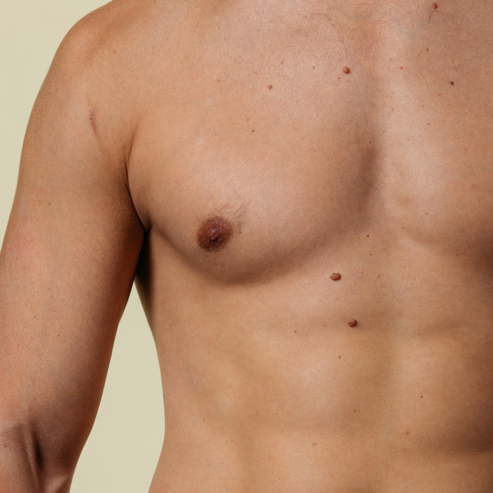 A close-up of a shirtless man's upper torso and chest, showing skin texture, moles, and some body hair against a neutral background.