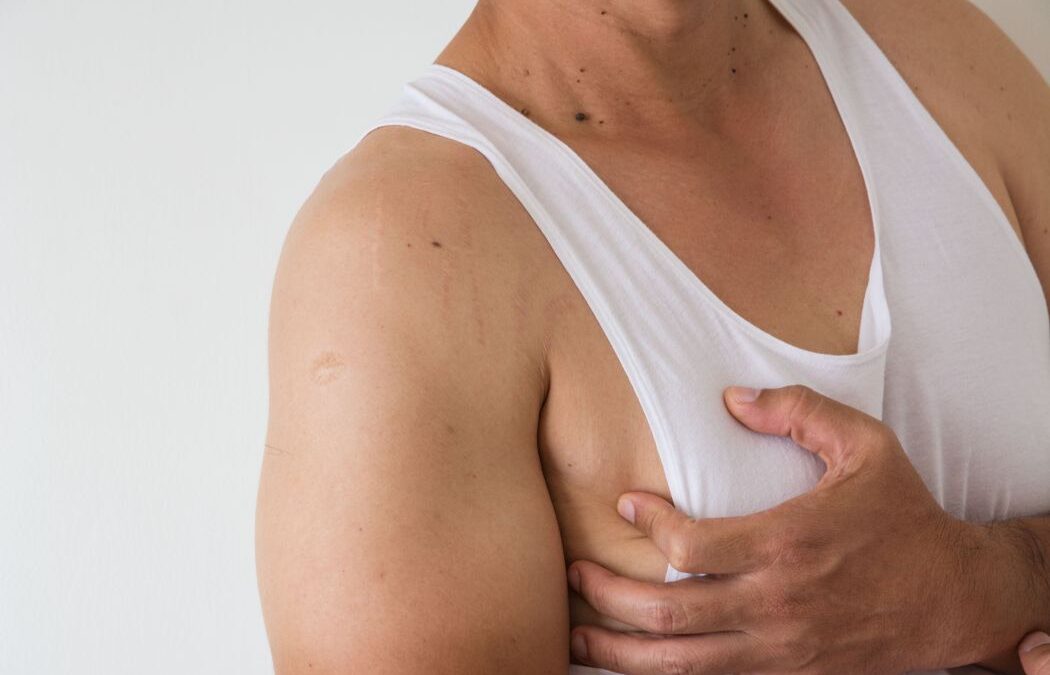 A person in a white tank top holds their upper arm, showing visible stretch marks and a small round scar on the shoulder.